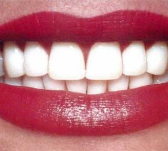 Diş Beyazlatma Teknikleri